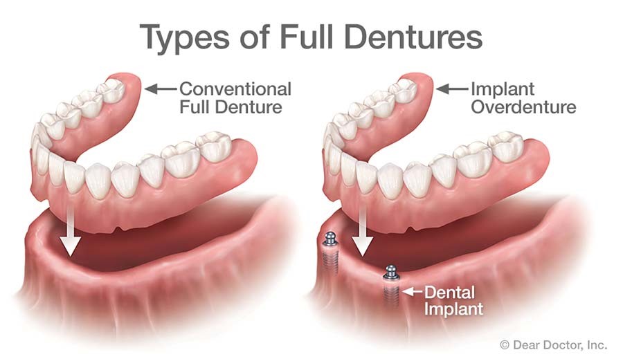 Partial Dentures Procedure Hammond IN 46320